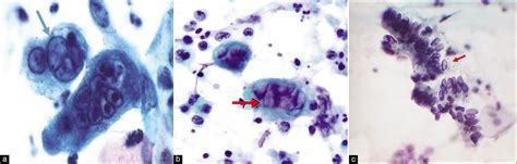 Inflammation on the Cervical Papanicolaou Smear: Evidence for Infection.